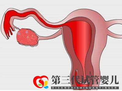 子宮肌瘤做俄羅斯試管嬰兒的成功率高嗎？(圖1)