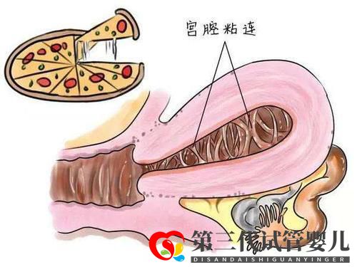 子宮粘連可以做試管嬰兒嗎？成功率高不高？(圖2)