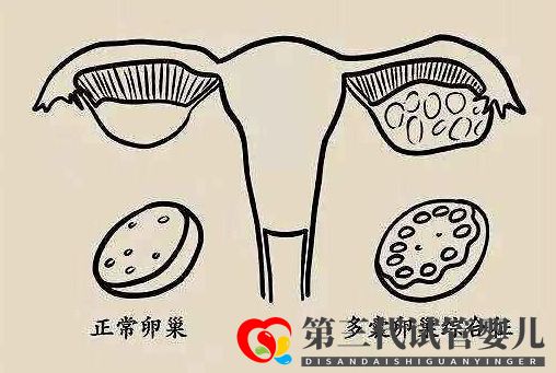 多囊促排懷孕成功率大嗎？(圖1)